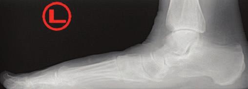 Preoperative AP radiograph consistent with collapsed pes valgus.