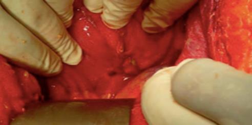 anastomosis, whereas 2 required stricturoplasty combined with the simple closure of the.