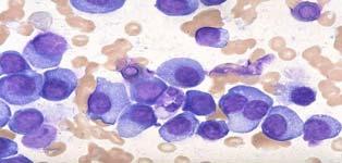 Treatment of Multiple Myeloma ovel Approaches Plasma cells in bone marrow Do
