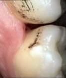 (B) Clinical features when cleaned using three way syringe, gingival appeared normal and no interproximal interference