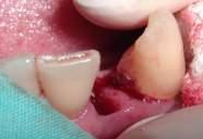 Bone grafts applied into the socket post removal of granulation