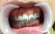 Also an emphasis on a cimbined periodontal-orthodontic approach cannot be ruled out in bringing the best results in smile design procedures.