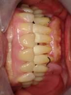 conditions (1). The most preferred restoration options like removable partial or complete dentures have several limitations.