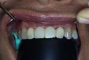 The temporary crown bridge was prepared before the third appointment. At this time, the old denture was removed and ready for preparation of abutment teeth (#12 and #22).