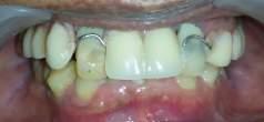 BACKGROUND Immediate denture is the best option to maintain patient confident during prosthodontic treatment.