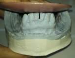 Occlusal Equilibrium with compensating curve 3. Selective grinding on patients remaining mandibular teeth using grinded study model as a guidance 4. Custom tray fabrication. 5.