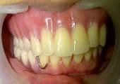 Insertion of maxillary bare root complete overdenture and mandibulary DISCUSSION Retaining teeth permit the stresses of occlusion to be borne partially by the teeth, thus reducing the abuse, which