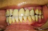 especially removable partial denture with wire or metal klasp retention.