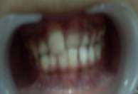 crossbite. There is 1.3 mm overbite and 1.5 mm overjet. Intra oral and extra oral examination is healthy and have no abnormalities.
