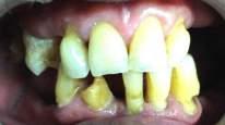 BACKGROUND Flat residual ridge usually came with stability and retention problem for denture fabrication.