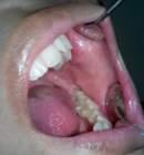 Control 1, November 16, 15. Patient says that the mouth ulcer has healed after scalling.