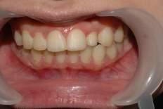 Figure 1. # 22 microdontia and palatoversion Owing to its minimally invasive nature and excellent aesthetic qualities it was decided to enhance her appearance using porcelain laminate veneers.