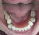 picture 9. Intra oral image after insertion Patient was instructed to use the dentures on first 24 hours and not to replace the dentures even she slept.