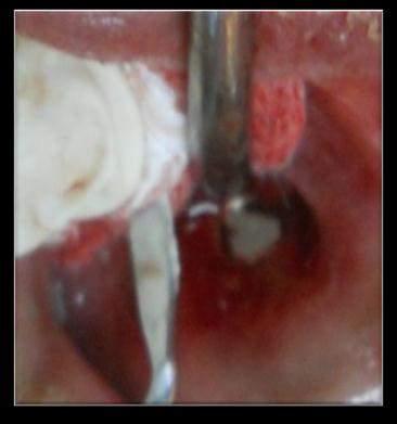 Then we end list the step of the operation, like : disinfection the operation area, infiltration anasthesi supraperiosteal at apex region of teeth 21 with phcaine 2 cc, flap incision semilunar region
