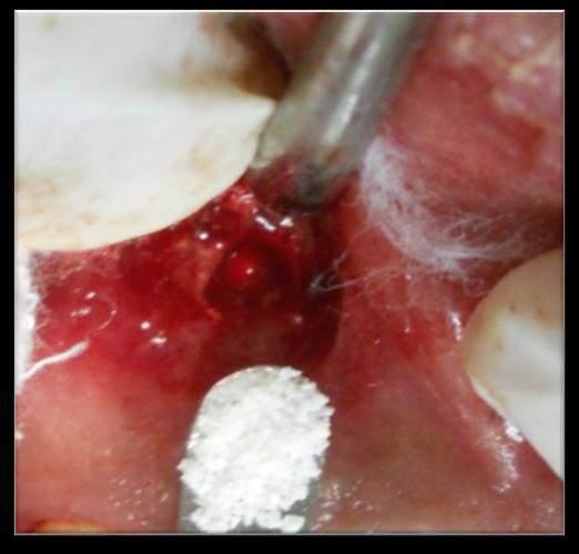 Figure 7 : Bone graft aplication Figure 8 : Suturing