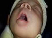 BACKGROUND Cleft lip and palate are one of the most common structural birth defects.