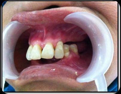 In many cases, this undergoing situation continues without any posibility of treatment, which aim to the loss of teeth.