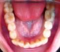 The intra-oral photos before orthodontic treatment DIAGNOSIS Angle Class I malocclusion with anterior crowding RA and RB,cusp to cusp