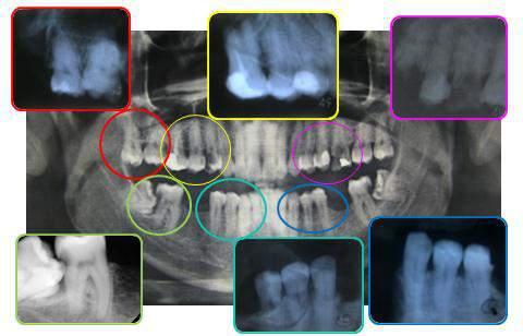 Radiographic analysis sukhoi SJ 100A DISCUSSION Radiography may reveal the identity of a person who is not obtained from the clinical examination Radiographs and can provide information that estimate