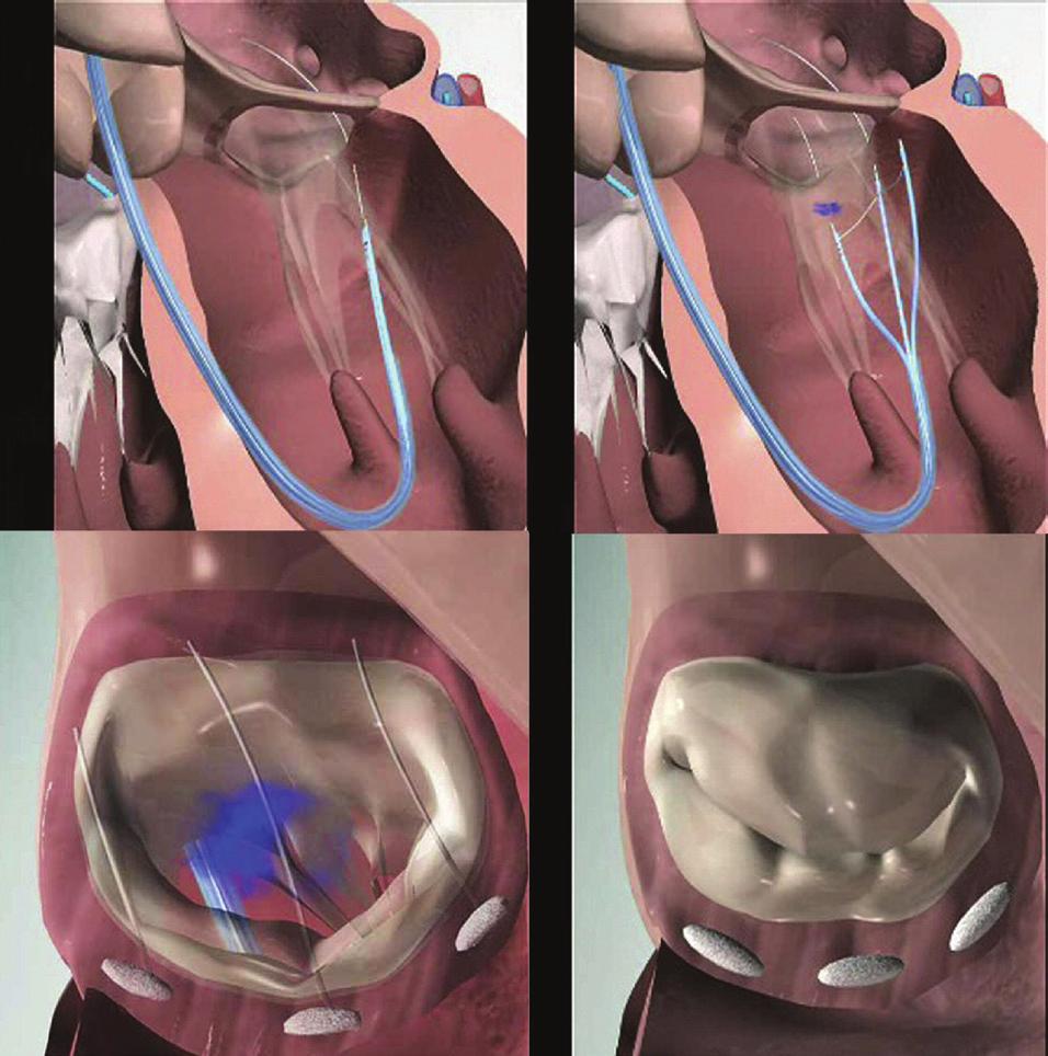 Figure 3. The Cardioband device. efficacy endpoints at 12 months and will follow patients to document long-term safety. Figure 2. The Mitralign system. patients with this anatomical presentation.