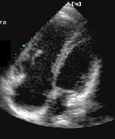 9. A classic M-mode finding for this patient is: O a) delayed tricuspid closure O b) early