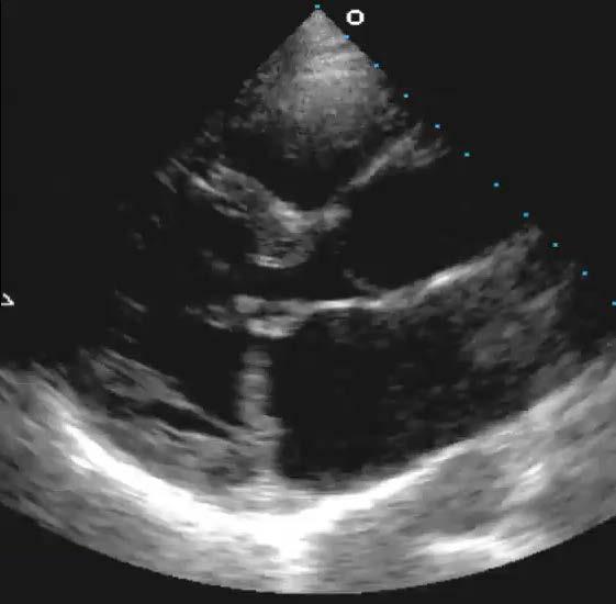 1. This patients mitral valve leaflets are best described as: O a) normal O b) normal
