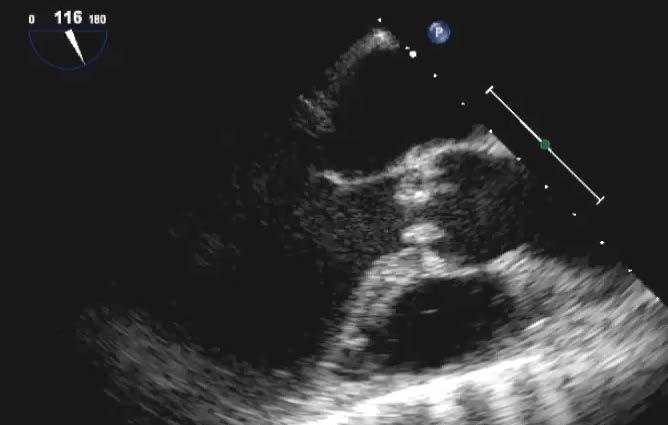 5. This echocardiogram shows which of the following findings?