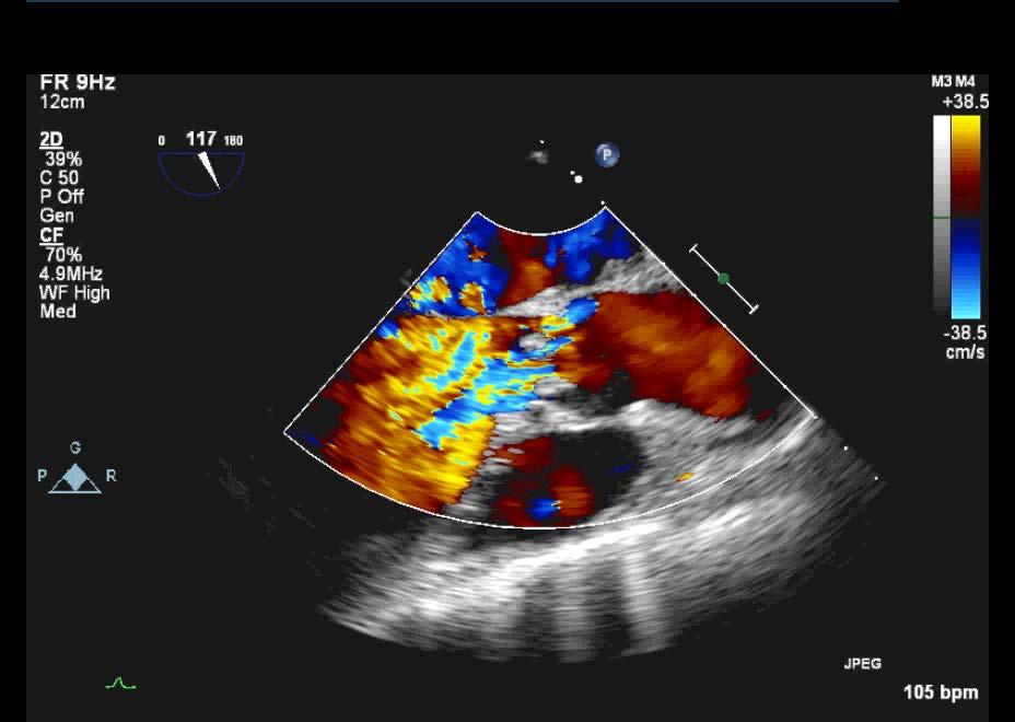6. This echocardiographic image shows: O a) mitral stenosis O b) aortic