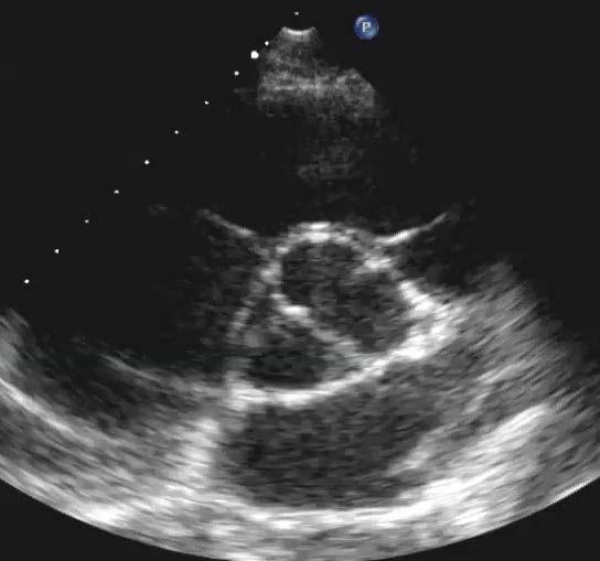9. Based on this parasternal shortaxis image what other cardiac abnormality would you look for?