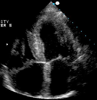 3. In the apical 4ch view, why does the interatrial septum appear so fat?