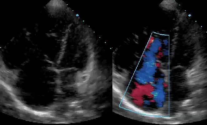 9. The tricuspid regurgitation by color Doppler: a) is severe O b) shows pulmonary