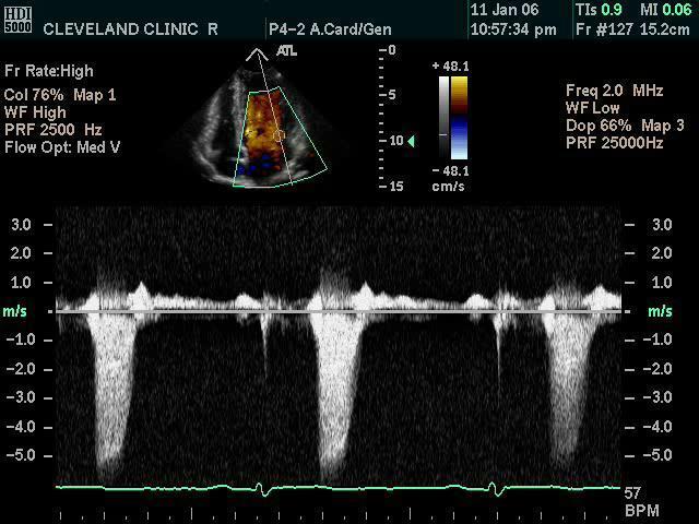 Mitral CW Doppler Can Show This Easily MV closure MR