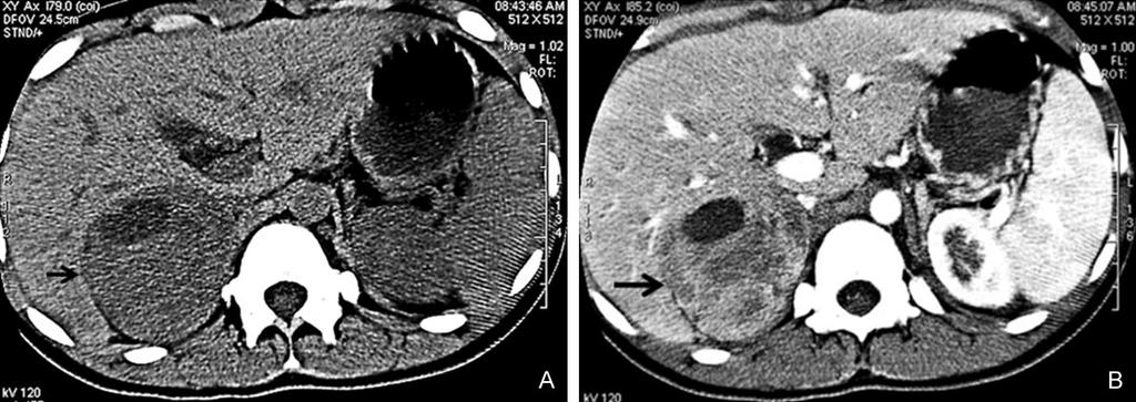 Figure 1. Computed tomography (CT) images of right adrenal mass. A: Unenhanced axial CT images shows a uneven mass (black arrow) about 8.5 cm 6.