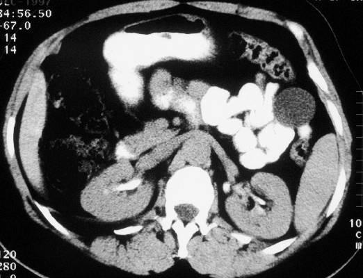 Below the splenic flexure of the colon and adjacent to the