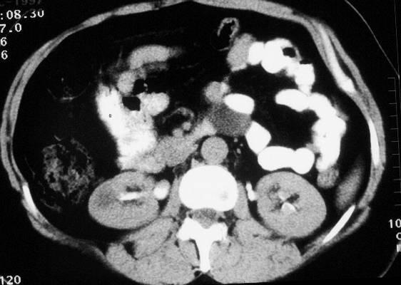 Figure 3 Abdominal scan at the level of the kidneys reveals a