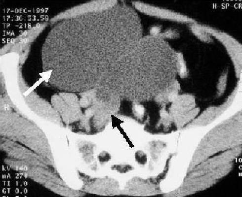 Figure 4 Pelvic scan at the level of the iliac crests demonstrates a large cystic lesion (white arrow) with