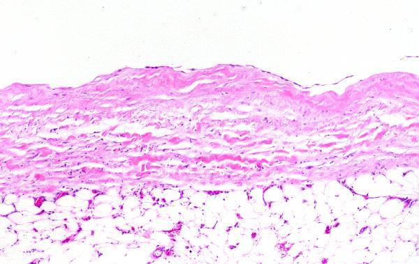 Figure 5 Wall of a cyst in the peritoneal surface of the bladder (H&E 4x). Mesothelial cells lining the inner surface of the cyst (H&E 4x).