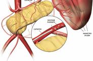 Peritoneal relations The spleen is surrounded by peritoneum and is suspended by multiple ligaments, as follows: The gastrosplenic ligament extends