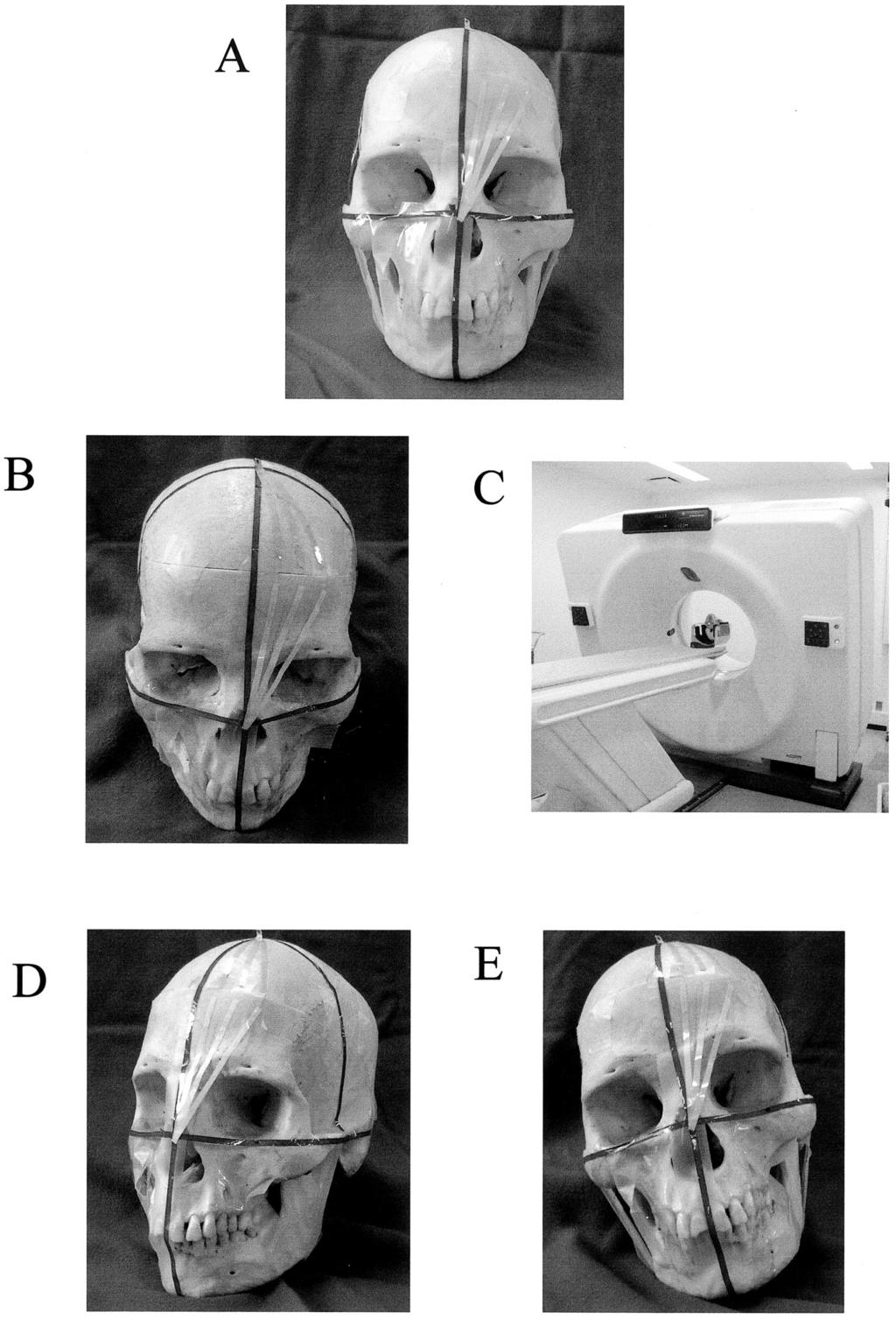 3-D CEPHALOMETRY USING HELICAL COMPUTER TOMOGRAPHY 517 FIGURE 2. The tapes along the horizontal plane, frontal plane, and sagittal plane were placed onto a skull.