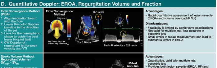 Chronic Aortic Regurgitation by Doppler Echocardiography * Specific Criteria for Mild AR VC width < 0.