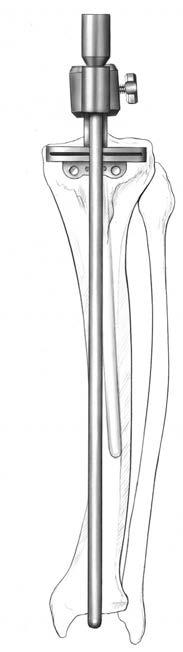 11 NexGen Intramedullary Instrumentation Surgical Technique Figure 18 Figure 19 Step Six: Cut the Proximal Tibia (cont.