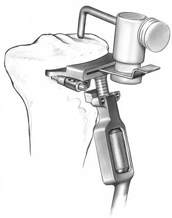 14 NexGen Intramedullary Instrumentation Surgical Technique Figure 25 Figure 26 Step Six: Cut the Proximal Tibia (cont.
