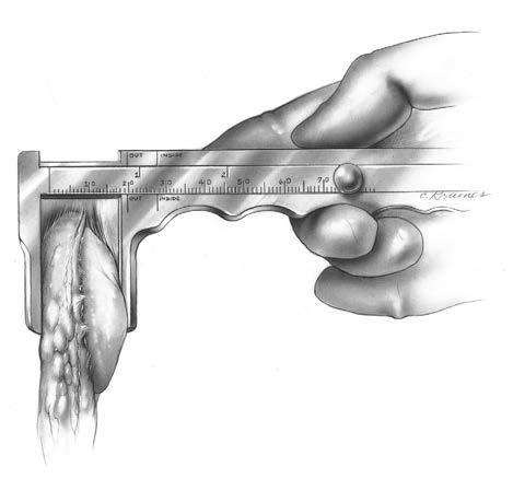16 NexGen Intramedullary Instrumentation Surgical Technique Figure 30 Step Seven: Prepare the Patella Sharply dissect through the pre-patellar bursa to expose the anterior surface of the patella.