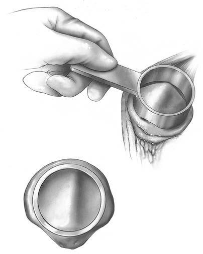 Choose the guide which will allow approximately 2 mm between the superior edge of the patella and the outer diameter of the guide (Figure 35).