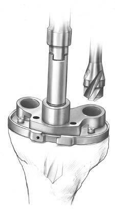 porous or cemented stem tibial drill (Figure 48).