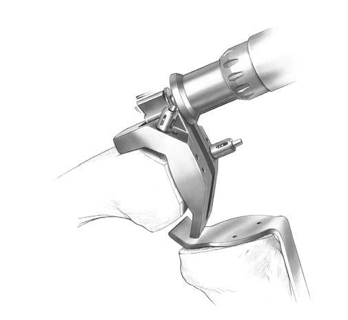 29 NexGen Intramedullary Instrumentation Surgical Technique Figure 59 Figure 61 Crossover Technique Options (When crossing over to a posterior stabilized design) Crossover Technique with the 5-in-1