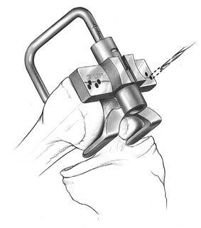 The hole should be approximately one centimeter anterior to the origin of the posterior cruciate ligament. The step drill can be used to enlarge the entrance hole on the femur to 12 mm in diameter.