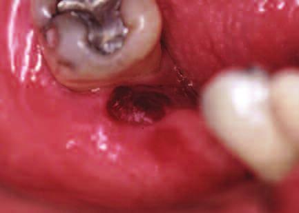 extensive ulcerated areas that can be denominated as desquamative gingivitis.