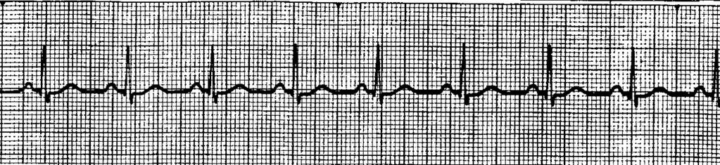 Review of some common ECG tracings NORMAL SINUS RHYTHM RATE: 60-100 bpm RHYTHM: Regular P-R INTERVAL: < 0.