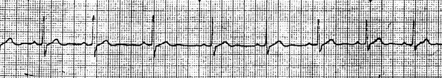 : Nothing IDENTIFYING FEATURES: o RATE < 60 bpm o ALL Other Criteria Normal SINUS ARRHYTHMIA RATE: Usually 60-100 bpm RHYTHM: Irregular P-R